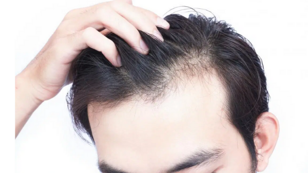 How to counter hair loss gafencu magazine