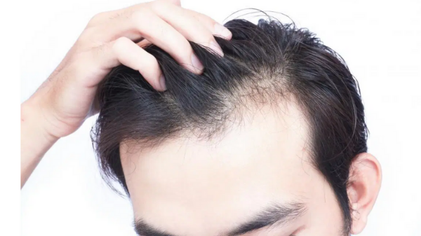 Combat male hair loss with these innovative procedures